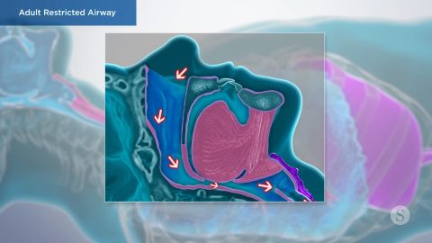 Adult Restricted Airway