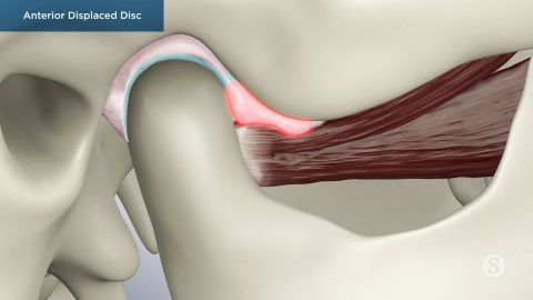 Anterior Displaced Disc