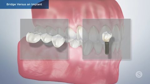 Bridge Versus an Implant