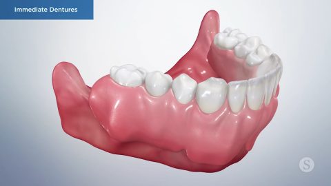 Immediate Denture