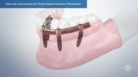 Post-Op Instructions for Fixed-Hybrid Denture Placement