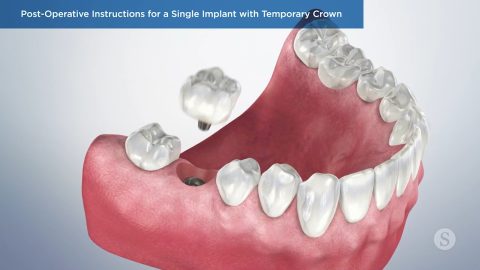 Post Operative Instructions Single Implant with Temporary Crown