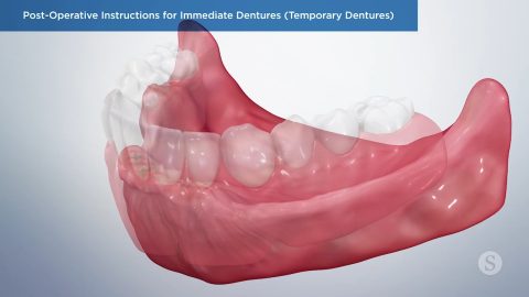 Post-Operative Instructions for Immediate Dentures (Temporary Dentures)