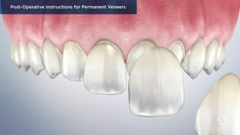 Post-Operative Instructions for Permanent Veneers