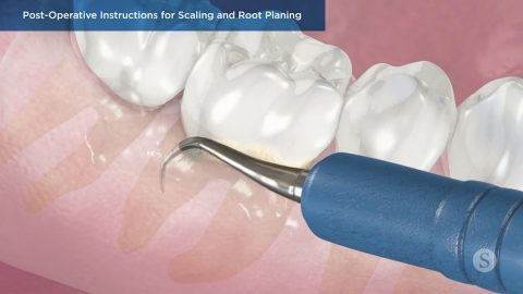 Post-Operative Instructions for Scaling and Root Planing