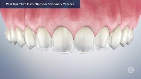 Post-Operative Instructions for Temporary Veneers