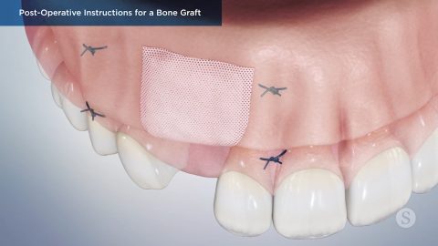 Post-Operative Instructions for a Bone Graft