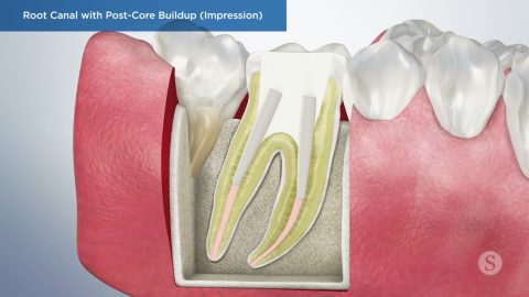 Root Canal with Post-Core Buildup (Impression)