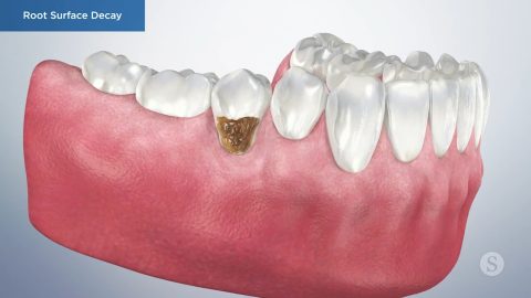 Root Surface Decay