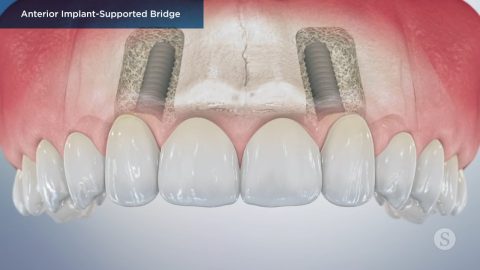 Vertical Root Fracture