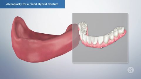 Alveoplasty for a Fixed-Hybrid Denture