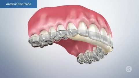 Anterior Bite Plane