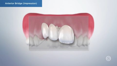 Anterior Bridge (Impression)