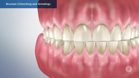 Bruxism (Clenching and Grinding)