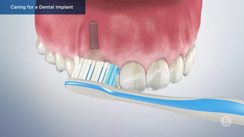 Caring for a Dental Implant