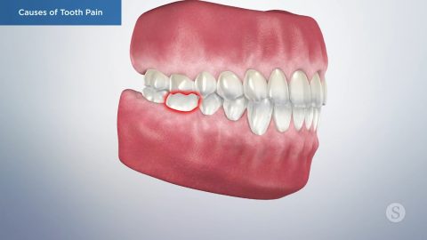 Causes of Tooth Pain