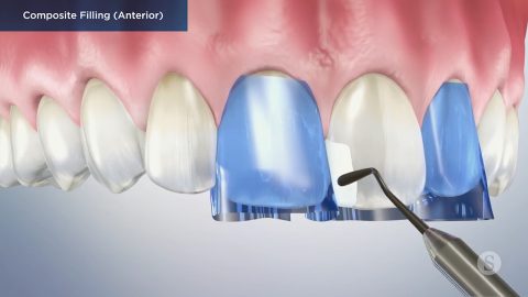 Composite Filling (Anterior)