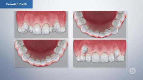 Crowded Teeth