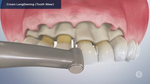 Crown Lengthening (Tooth Wear)