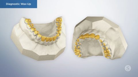 Diagnostic Wax-Up