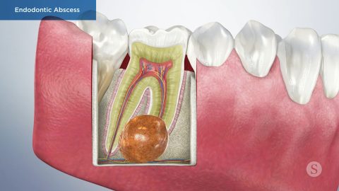 Endodontic Abscess