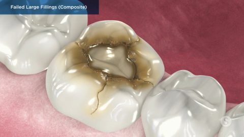 Failed Large Fillings (Composite)