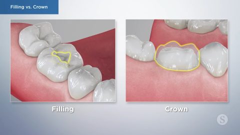 Filling vs. Crown