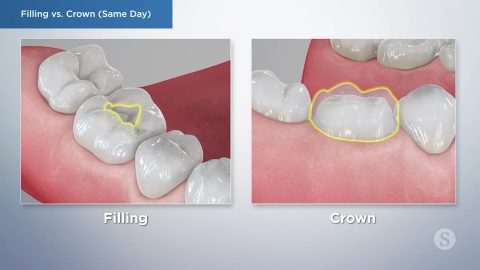 Filling vs. Crown (Same Day)