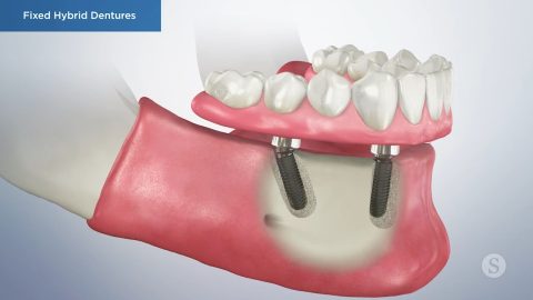 Fixed Hybrid Dentures