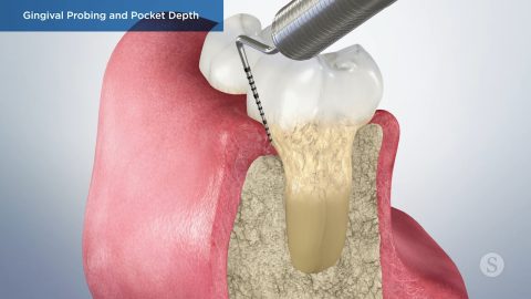 Gingival Probing and Pocket Depth