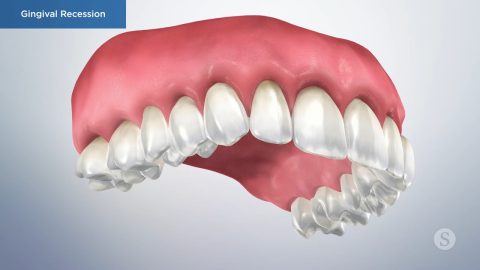 Gingival Recession