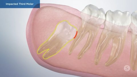 Impacted Third Molar