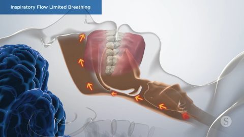 Inspiratory Flow Limited Breathing