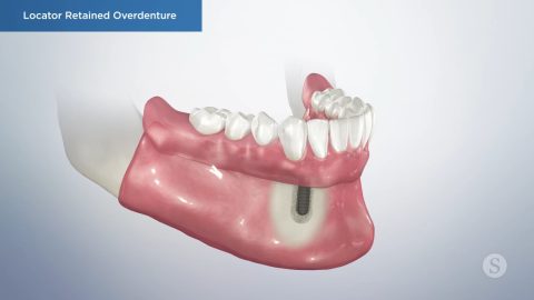 Locator Retained Overdenture