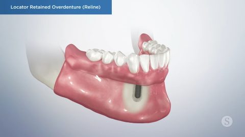 Locator Retained Overdenture (Reline)