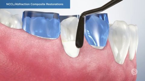 NCCL/ Abfraction Composite Restorations