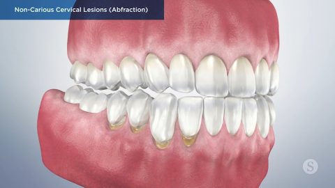 Non-Carious Cervical Lesions (Abfraction)