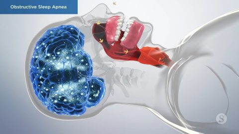 Obstructive Sleep Apnea