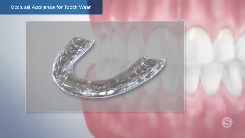 Occlusal Appliance for Tooth Wear