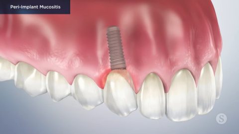 Peri-Implant Mucositis