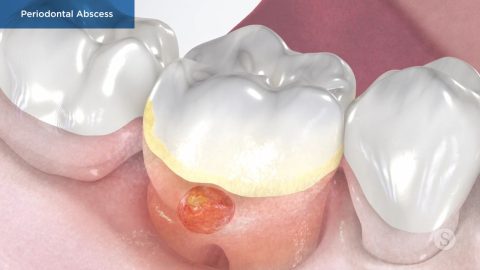 Periodontal Abscess