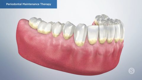 Periodontal Maintenance Therapy