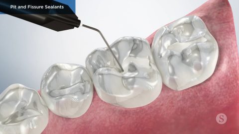 Pit and Fissure Sealants