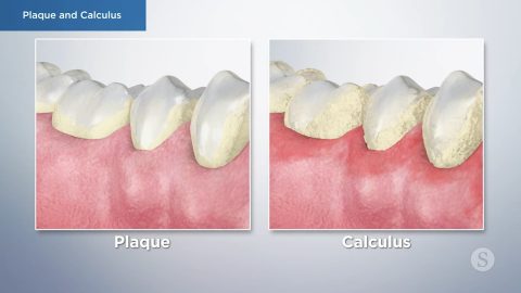 Plaque and Calculus