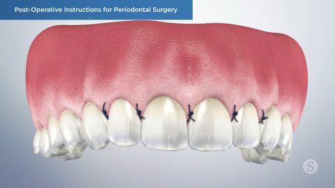 Post-Operative Instructions for Periodontal Surgery