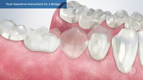 Post-Operative Instructions for a Bridge