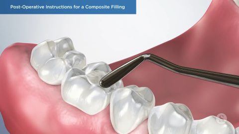 Post-Operative Instructions for a Composite Filling