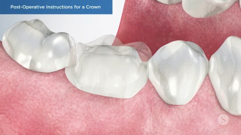 Post-Operative Instructions for a Crown