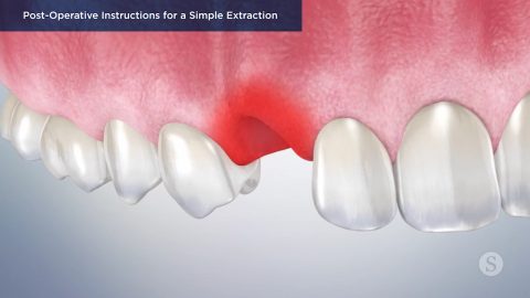 Post-Operative Instructions for a Simple Extraction