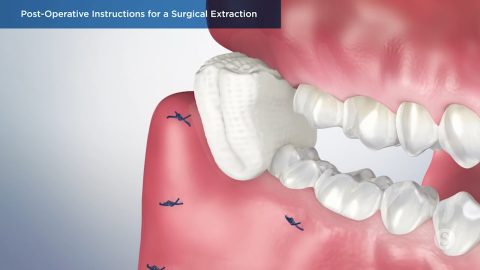 Post-Operative Instructions for a Surgical Extraction